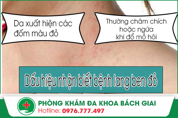 Những dấu hiệu nhận biết mắc bệnh lang ben đỏ