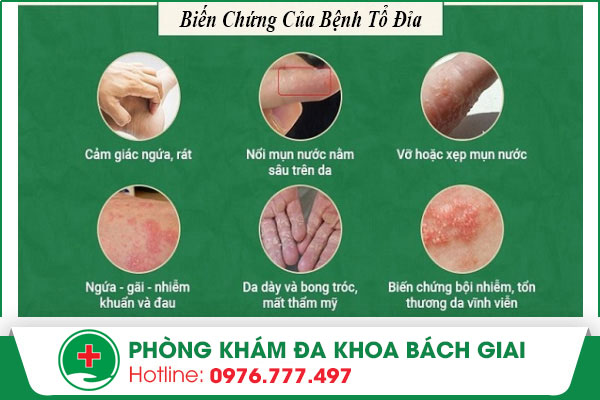 lòng bàn tay ngứa nổi hột