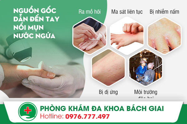 Các căn nguyên khiến tay nổi mụn nước