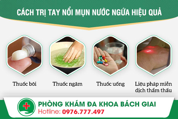 Các phương pháp điều trị tay nổi mụn nước được nhiều chuyên gia hàng đầu khuyên dùng