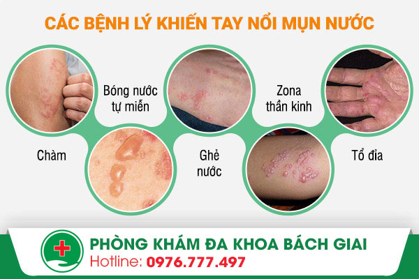 Tay nổi mụn nước là biểu hiện của bệnh gì?