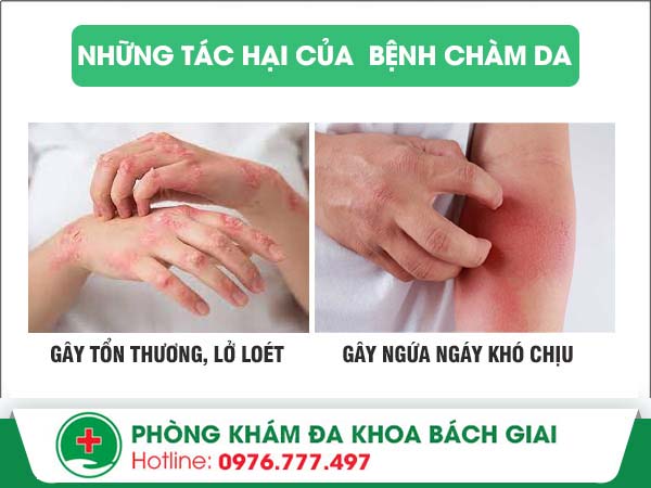 Những tác hại nguy hiểm của bệnh chàm – Bạn đã biết!