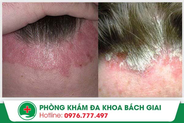 Một số bệnh da đầu thường gặp – Hãy chú ý!