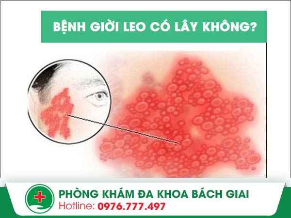 Bệnh giời leo có thể bị lây không?