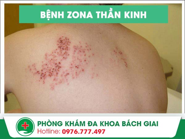 Những điều bạn nên biết về căn bệnh zona