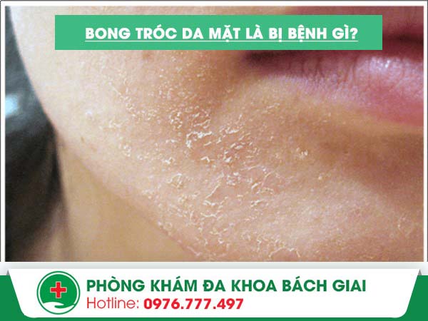 Bong tróc da mặt là dấu hiệu của bệnh gì?