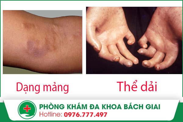 Bệnh xơ cứng bì khu trú với những hiểm họa khôn lường