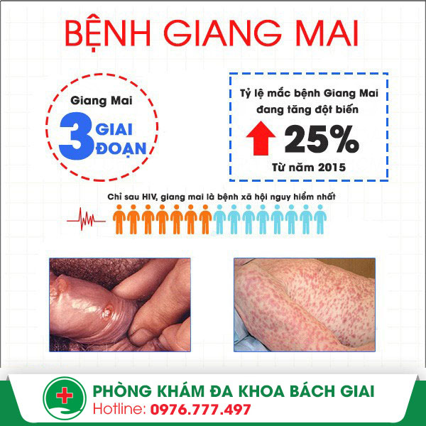 Bệnh giang mai có chữa khỏi được không?