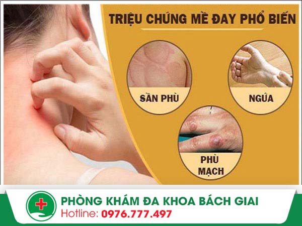 Cách chữa mề đay loại bỏ ngay triệu chứng mẩn ngứa