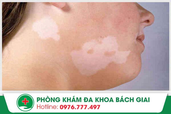 Bệnh bạch biến là gì? Bạn đã biết phân biệt giữa bạch biến và bạch tạng?