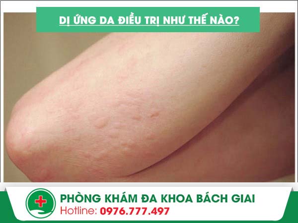 Phương pháp nào điều trị dị ứng an toàn – Hiệu quả?