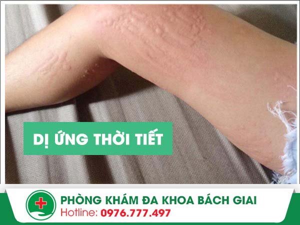 Mách bạn cách điều trị dị ứng thời tiết