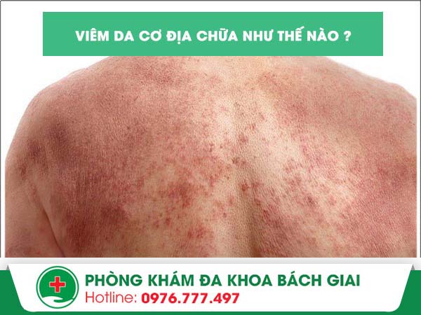 Mách bạn cách điều trị viêm da cơ địa hiệu quả – nhanh chóng