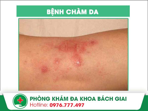 Chàm da là bệnh gì? Phương pháp nào điều trị hiệu quả?