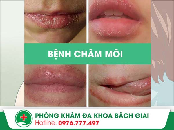 Bạn có đang bị nhầm lẫn giữa chàm môi – khô môi- hay nứt môi thông thường?