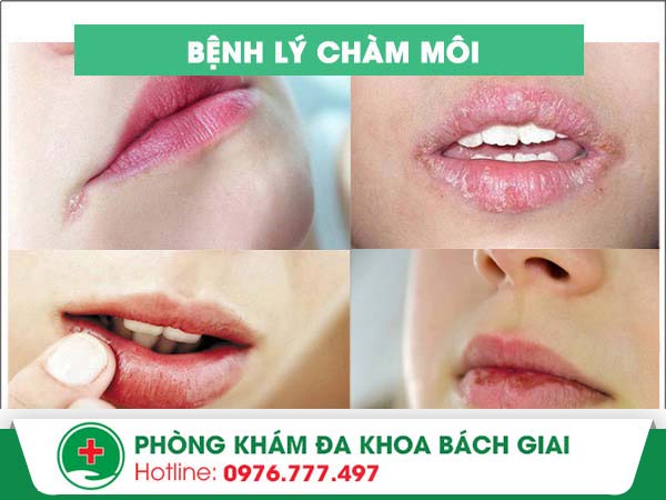 Cách điều trị bệnh chàm môi nào an toàn và đơn giản nhất?