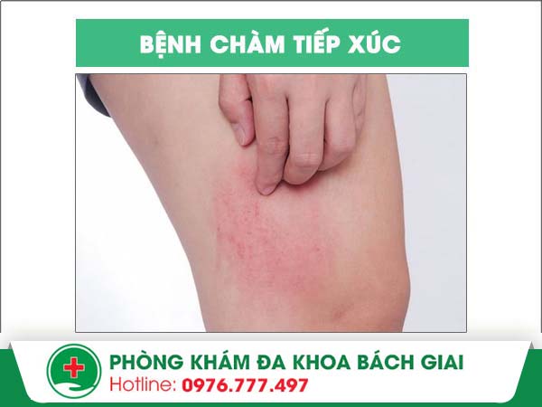 Những điều bạn nên biết về bệnh chàm tiếp xúc và phương pháp điều trị