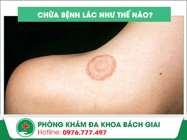 Phương pháp nào chữa lác an toàn – Hiệu quả?