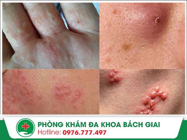 Bí quyết chữa mụn ngứa nhanh khỏi không để lại sẹo xấu