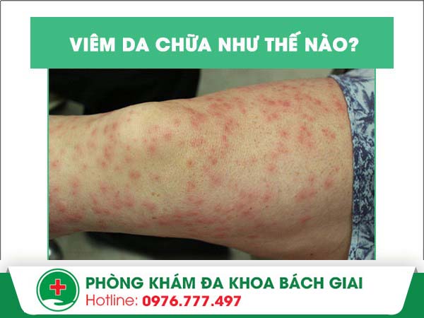 Mách bạn phương pháp điều trị viêm da hiệu quả – nhanh chóng – hạn chế tái phát