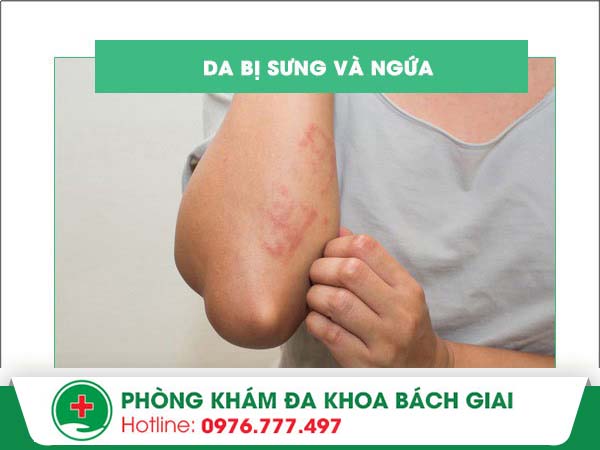 Da sưng ngứa là triệu chứng của vấn đề gì?