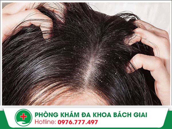 Lý do nào khiến da đầu bị hôi?