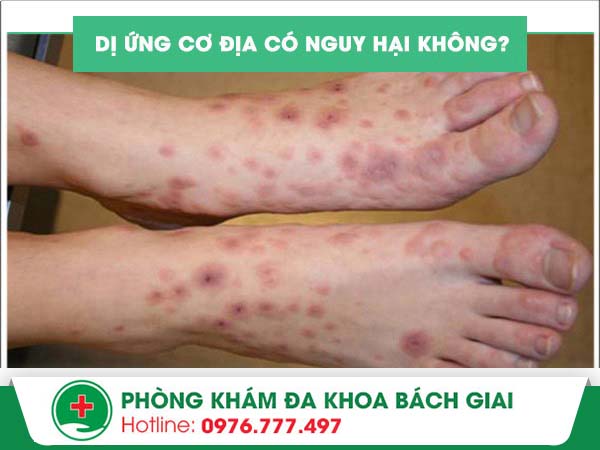 Bị dị ứng cơ địa có nguy hiểm không?