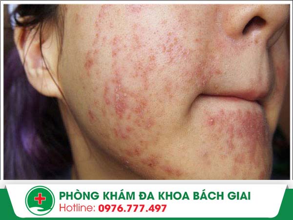 Lưu ý những thực phẩm không được ăn khi bị dị ứng