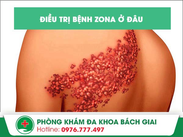 Mách bạn phương pháp điều trị bệnh zona an toàn – Hiệu quả