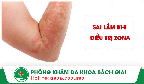 Những sai lầm thường gặp trong điều trị bệnh zona