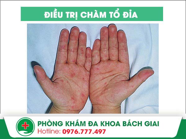 Điều trị chàm tổ đỉa hiệu quả không lo tái phát tại da liễu Đông Phương