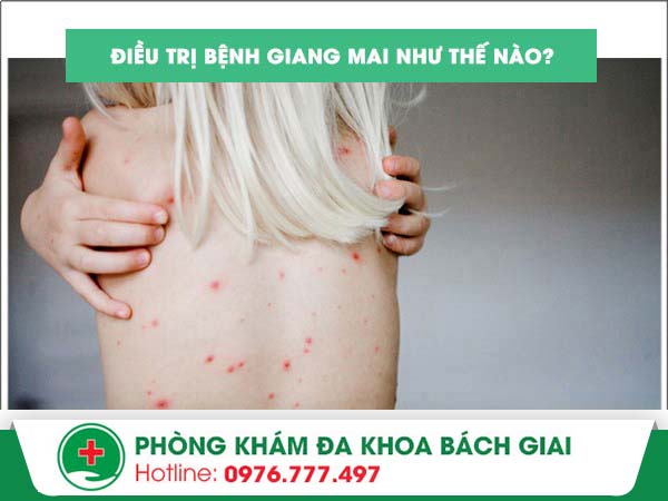 Điều trị giang mai bằng phương pháp nào hiệu quả?