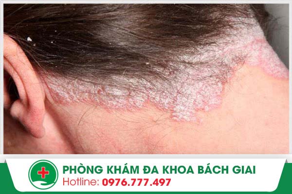 Mách bạn phương pháp điều trị bệnh vảy nến da đầu hiệu quả