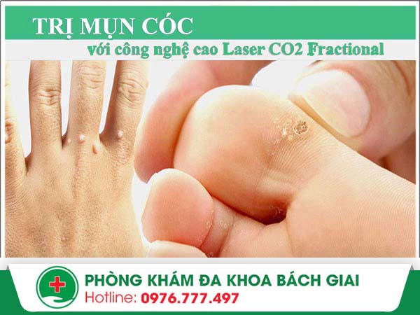 Đốt mụn cóc laser ở đâu an toàn tại Hà Nội?