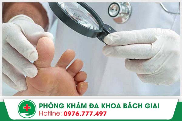 Không nên chủ quan với bệnh nấm móng