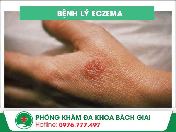 Phương pháp nào điều trị Eczema hiệu quả nhất?