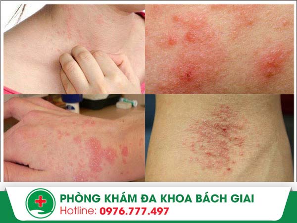 Eczema là bệnh gì? Phương pháp nào điều trị hiệu quả căn bệnh này?