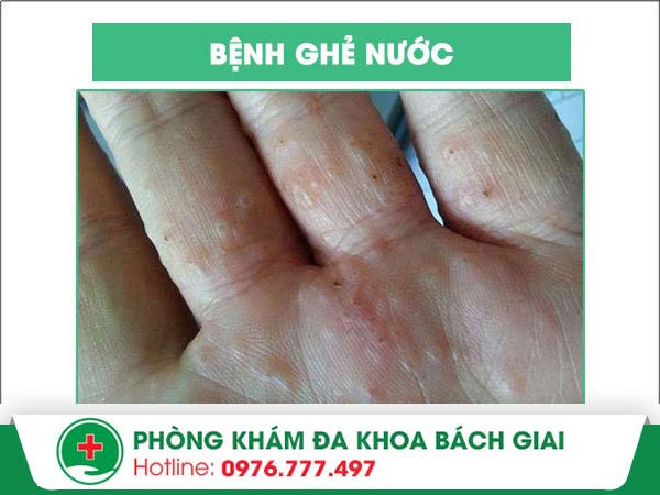 Bệnh ghẻ nước rất phổ biến và dễ lây lan nhanh – Bạn đã biết!