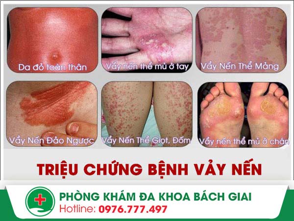 Xóa tan bệnh vảy nến bằng phương pháp tiên tiến