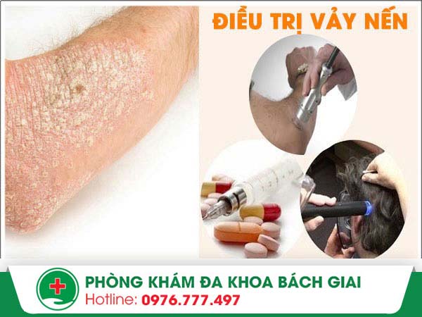 Những điều bạn nên biết về căn bệnh vảy cá