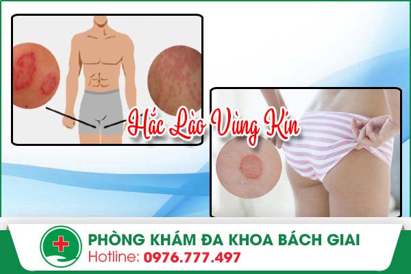 Hắc lào vùng kín ở Nam và Nữ giới – Có nguy hiểm không?