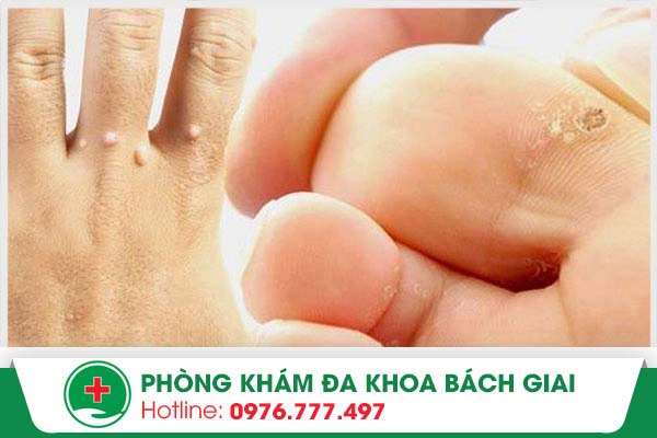 Hạt cơm – Bệnh ngoài da thường gặp bạn đã biết