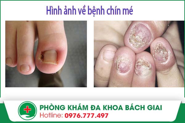 Những nguy hại “khôn lường” khi mắc phải bệnh chín mé