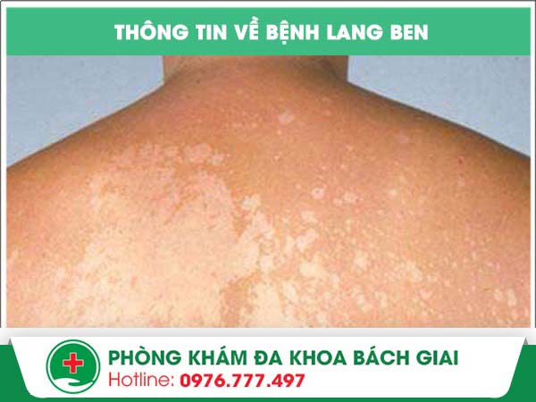 Những điều bạn nên biết về bệnh lang ben