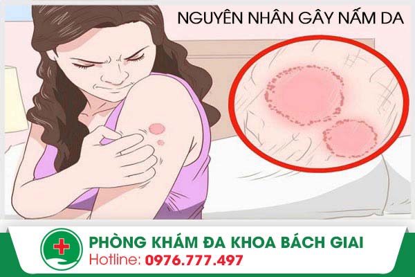 Mách bạn cách nhận biết bệnh nấm ngoài da