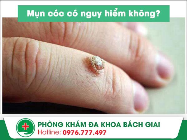 Bị mụn cóc có nguy hiểm không?