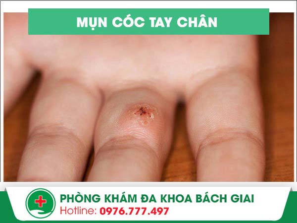 Làm thế nào để chữa mụn cóc tay chân hiệu quả?