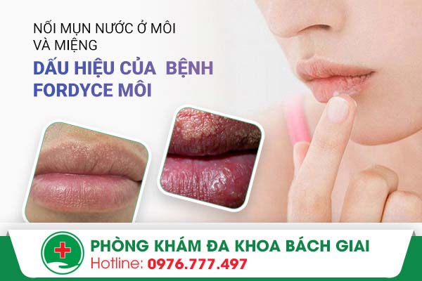 Nổi mụn nước ở môi và miệng là triệu chứng bệnh gì?