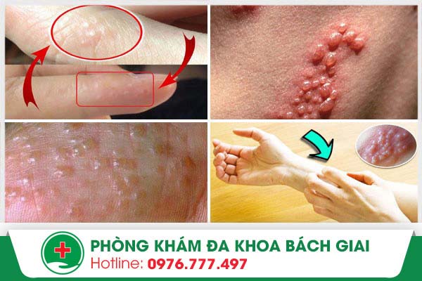 Mụn nước là triệu chứng của bệnh gì?