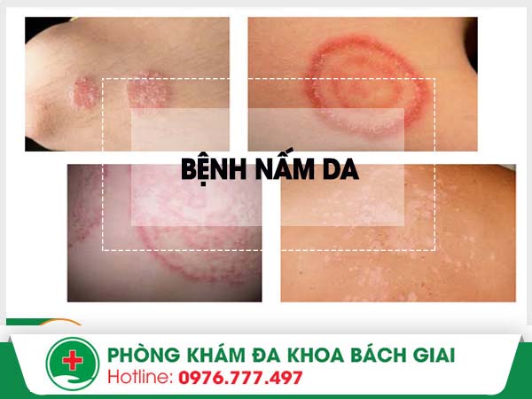 Các bệnh nấm da thường gặp và cách điều trị hiệu quả